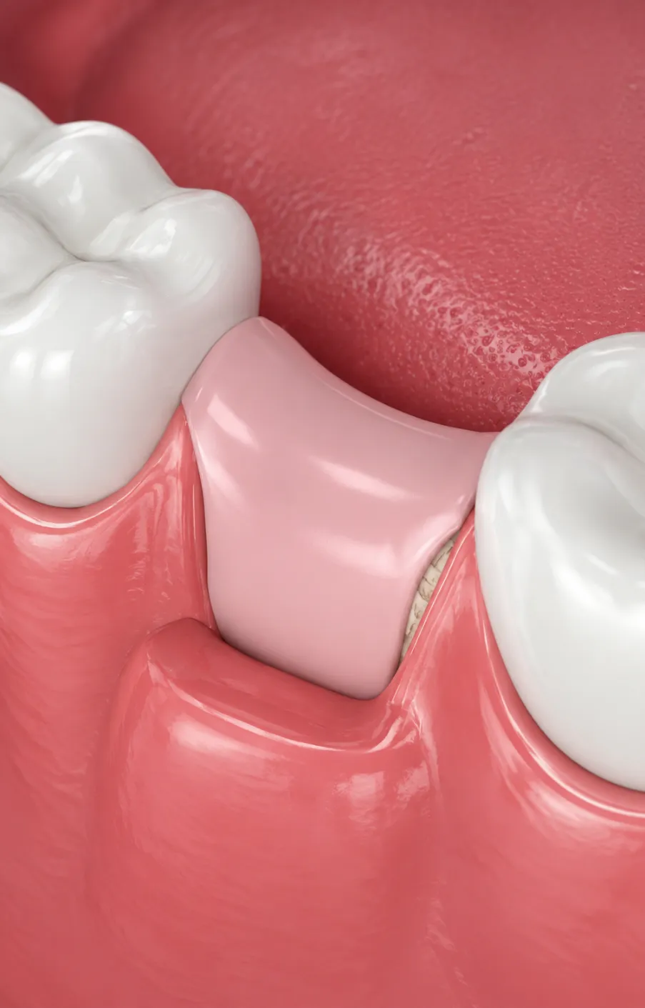 Bone Graft Surgery