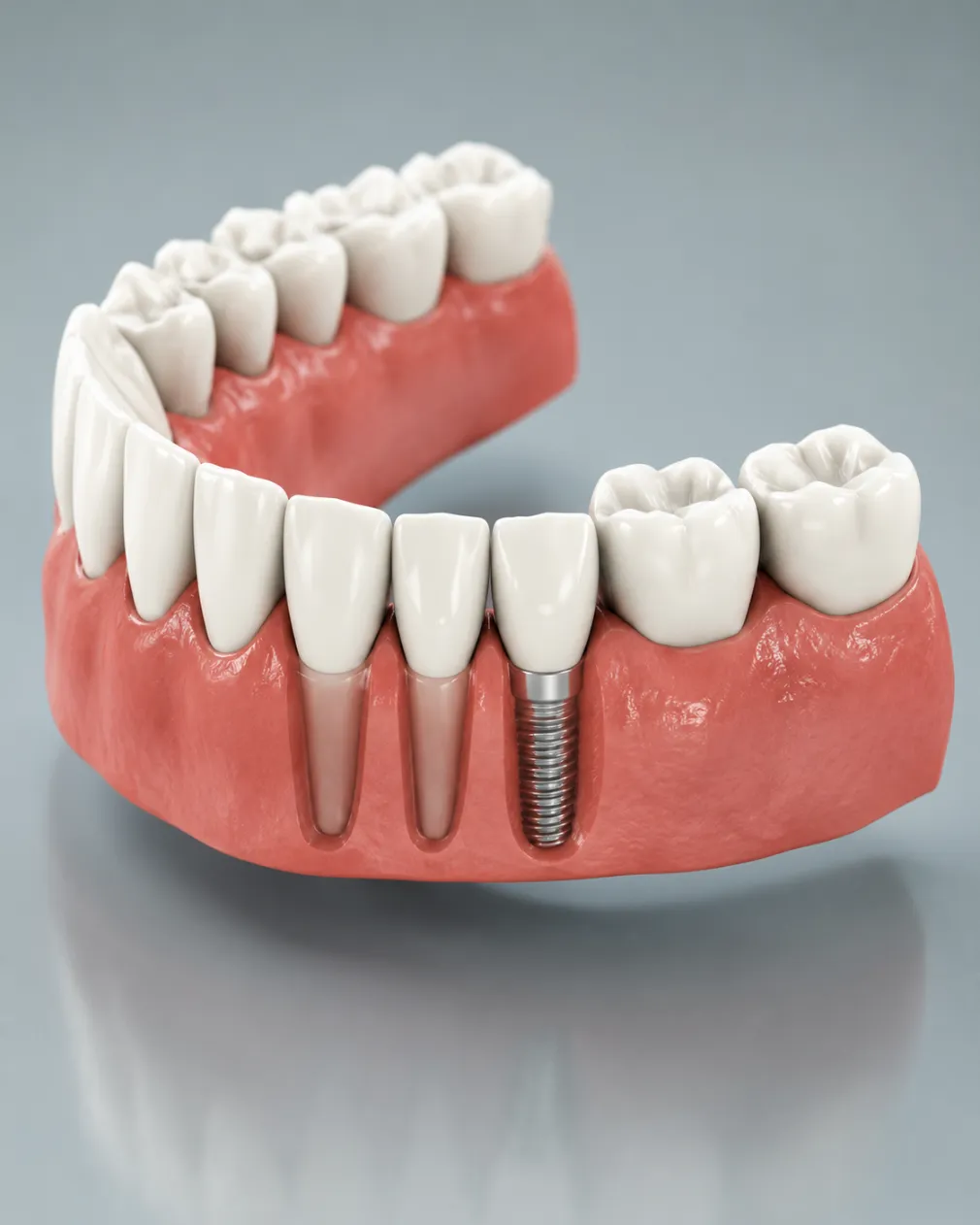 Dental Bridges