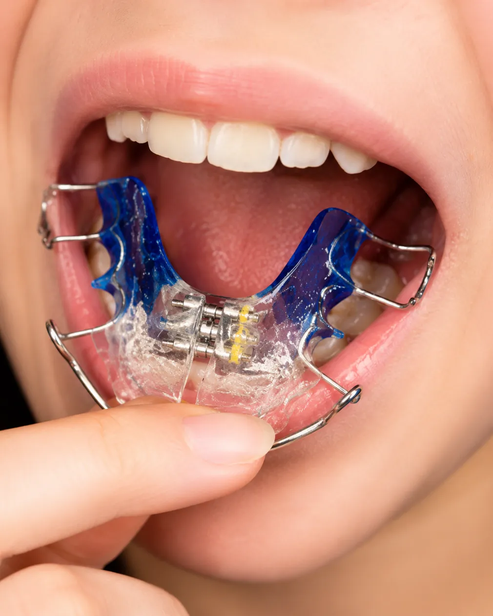 Palatal Expander