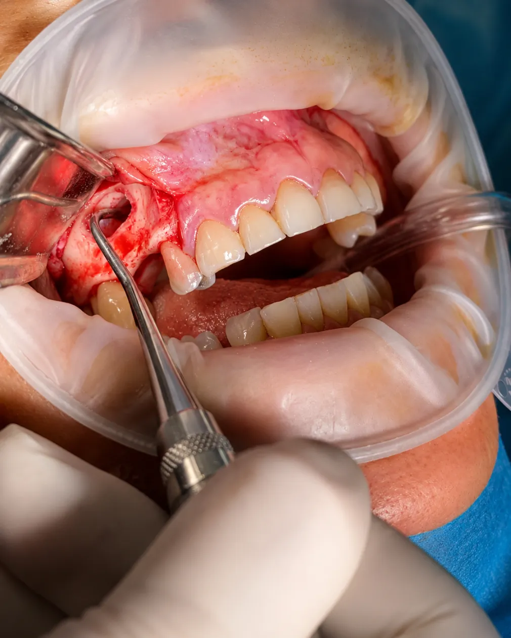 Sinus Surgery