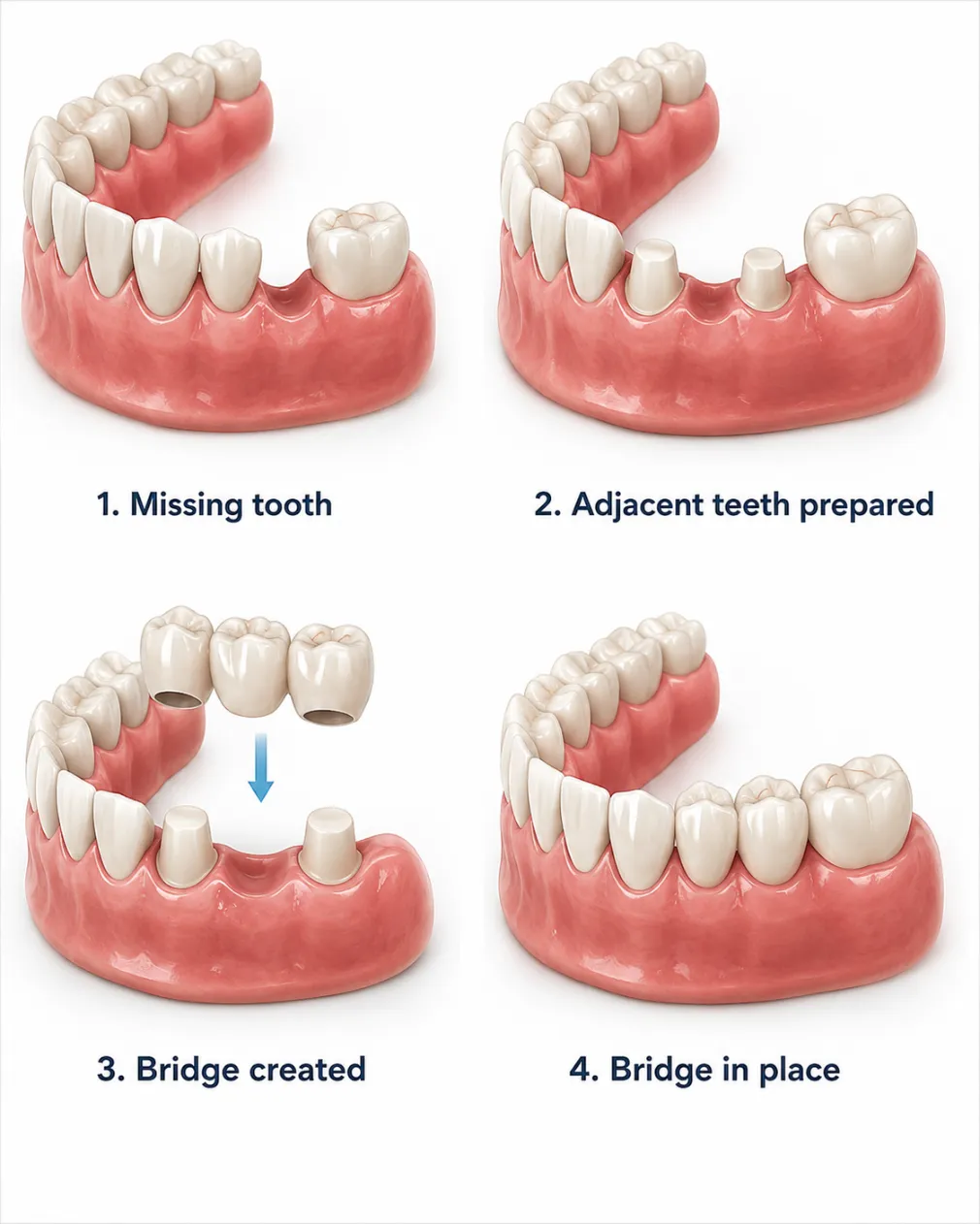 The Benefits of Dental Bridges