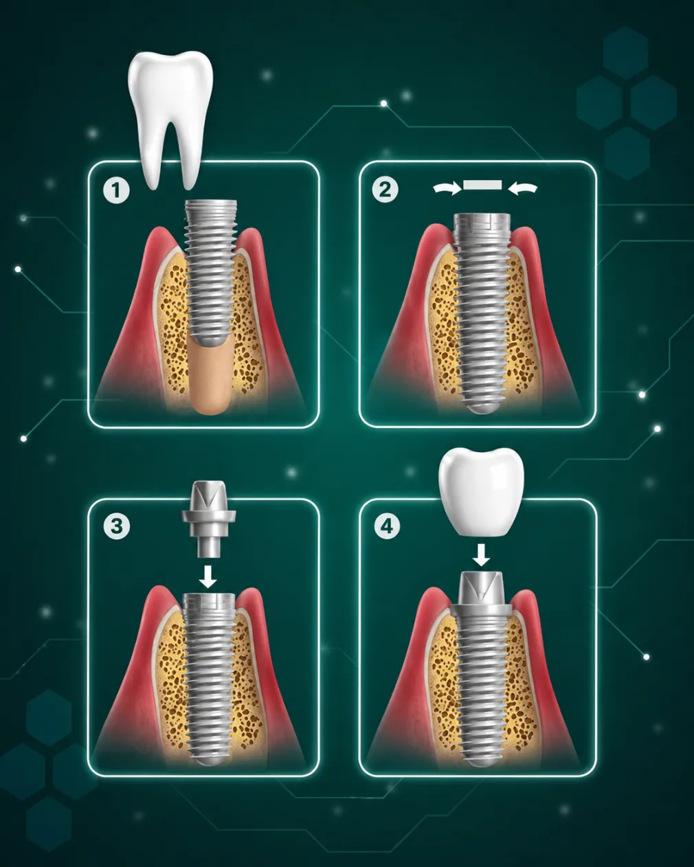Dental Implants