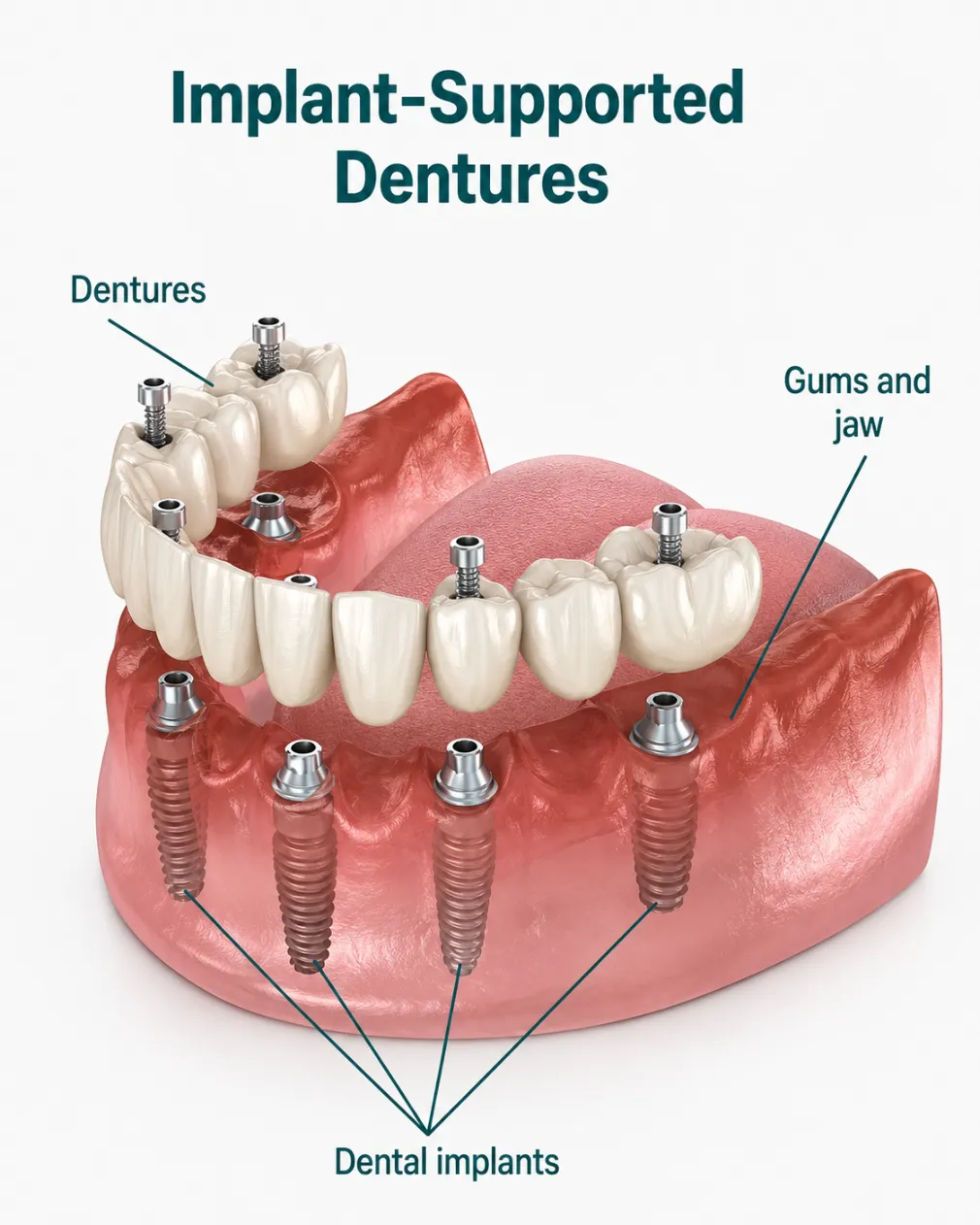 Implant Supported Dentures
