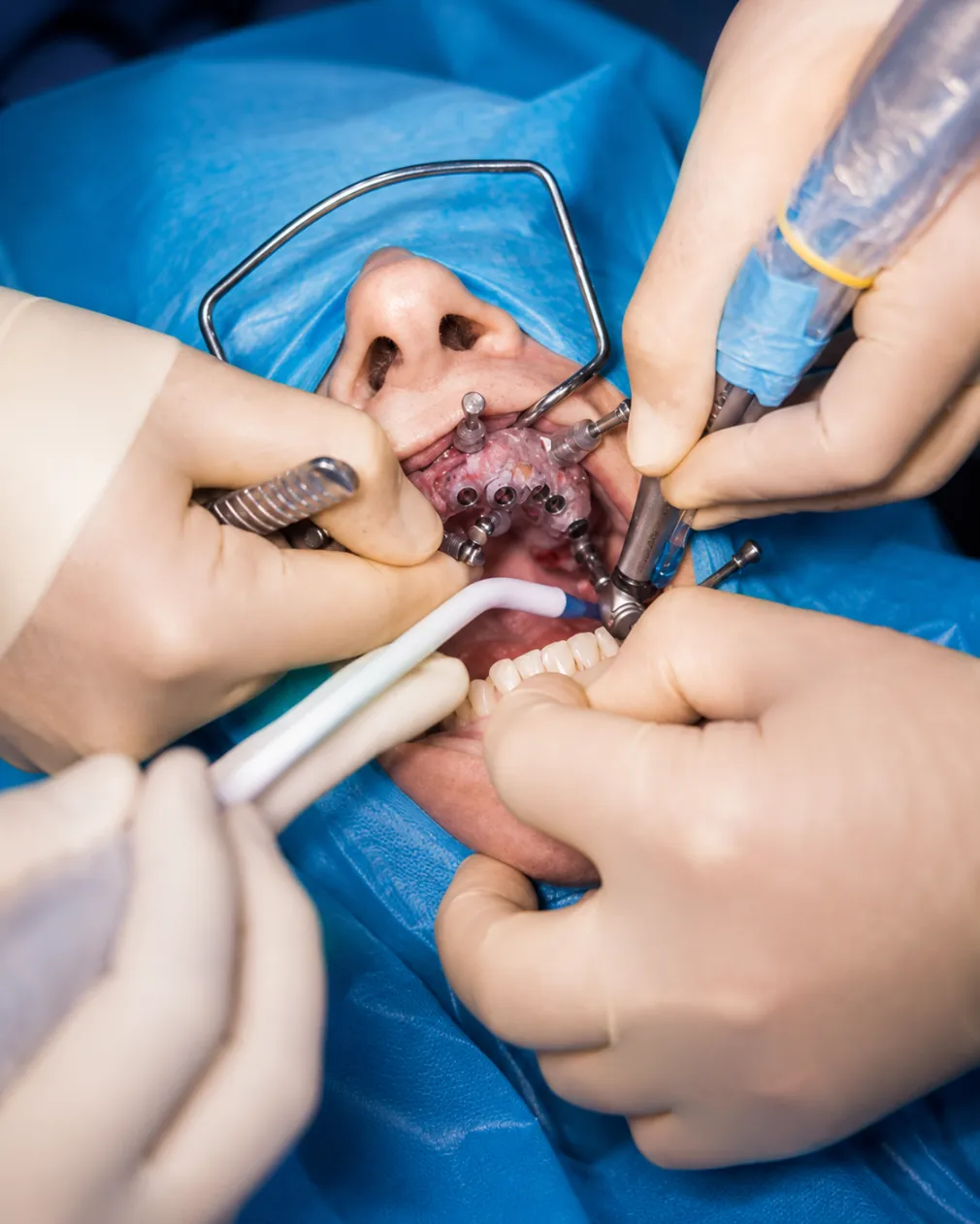 Wisdom Tooth Extraction