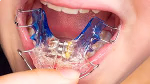 Palatal Expander