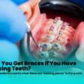 Can You Get Braces If You Have Missing Teeth?